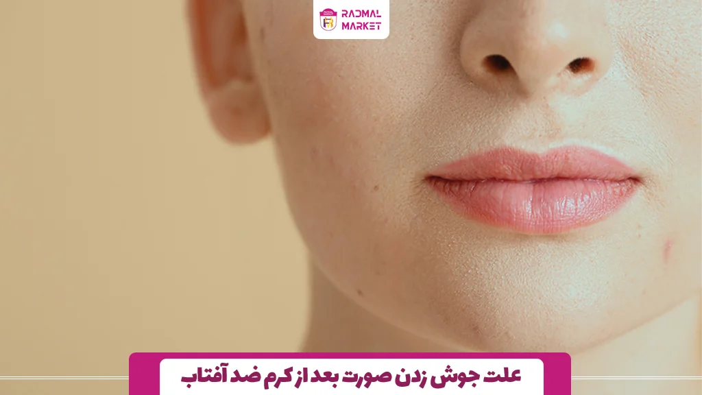 علت جوش زدن صورت بعد از کرم ضد آفتاب