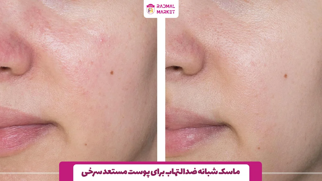 ماسک شبانه ضدالتهاب برای پوست مستعد سرخی 
